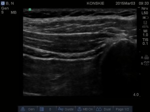 Sonoanatomia nerwów biodrowo-podbrzusznego (IhN) i biodrowo-pachwinowego (IiN)