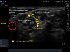 Nerw przeponowy, splot ramienny