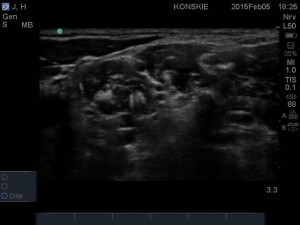 Nerw przeponowy, splot ramienny