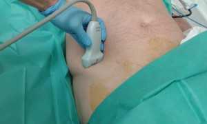 Lokalizacja nerwów biodrowo-podbrzusznego i biodrowo-pachwinowego