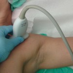 Dostęp podobojczykowy (VICA) - ułożenie głowicy