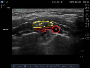 Splot ramienny w okolicy nadobojczykowej. Tętnica grzbietowa łopatki (DSA)