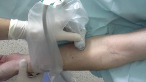 Ułożenie głowicy przy lokalizacji nerwu łokciowego na poziomie przedramienia