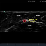 Sonoanatomia nerwu łokciowego (środek przedramienia)