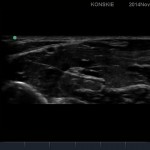 Sonoanatomia nerwu pośrodkowego  (środek przedramienia)