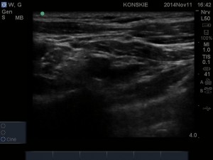 Sonoanatomia splotu ramiennego - dostęp LSICA