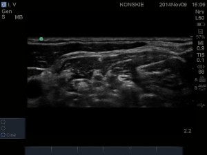 Sonoanatomi splotu ramiennego w szczelinie międzypochyłej