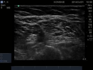 Sonoanatomia nerwu kulszowego w okolicy dołu podkolanowego.