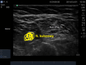 Sonoanatomia nerwu kulszowego w okolicy dołu podkolanowego.