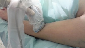 Ułożenie głowicy USG przy lokalizacji nerwu promieniowego na poziomie ramienia. Głowica USG położona w płaszczyźnie poprzecznej w jednej trzeciej dalszej ramienia