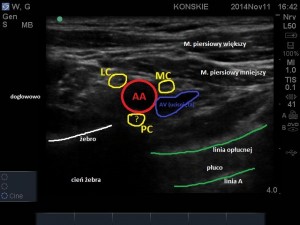 Sonoanatomia splotu ramiennego - dostęp LSICA