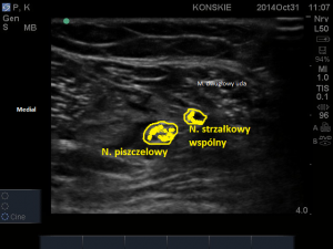 Nerw piszczelowy i strzałkowy wspólny w okolicy dołu podkolanowego (podział n. kulszowego)