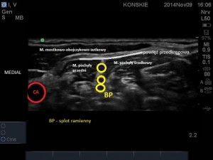 Sonoanatomi splotu ramiennego w szczelinie międzypochyłej