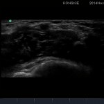 Sonoanatomia nerwu pośrodkowego (okolica nadkłykciowa)