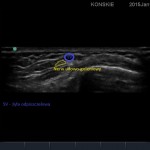 Sonoanatomia nerwu udowo-goleniowego na poziomie goleni