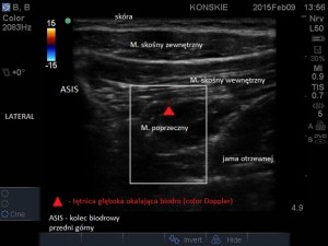 Tętnica głęboka okalająca biodro (color Doppler)