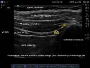 Sonoanatomia nerwów biodrowo-podbrzusznego (IhN) i biodrowo-pachwinowego (IiN)