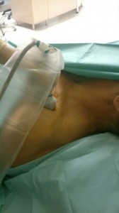 Dostęp podobojczykowy (LICA) - przyłożenie głowicy