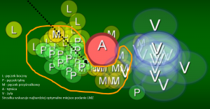Schemat prezentujący zmienność anatomiczną położenia struktur nerwowych splotu ramiennego w okolicy podobojczykowej (LIF Approach)