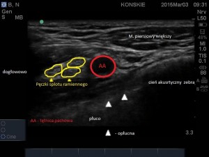 Sonoanatomia splotu ramiennego - dostęp VICA