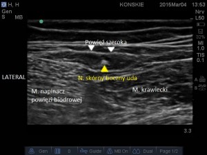 Sonoanatomia nerwu skórnego bocznego uda