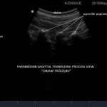 Paramedian Sagittal Transverse Process View