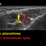 Nerw piszczelowy - sonoanatomia